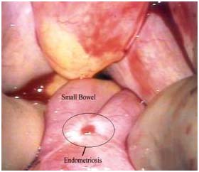endometriosis treatment
